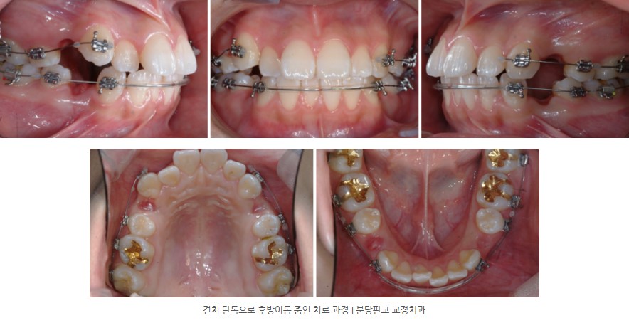 사춘기 치아교정 중 구내사진 분당교정치과 판교교정치과 서울리인치과