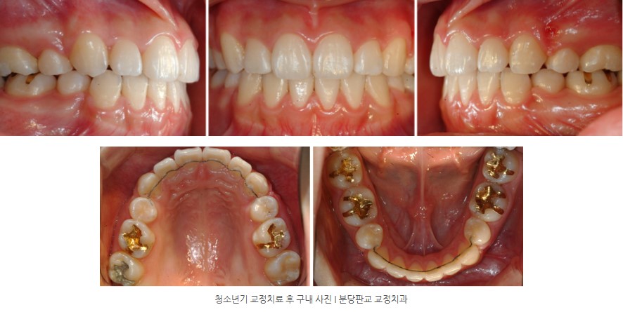 청소년기 치아교정 후 구내사진 분당교정치과 판교교정치과 서울리인치과