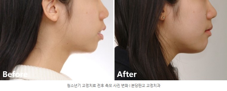 청소년기 치아교정 전후 측모 변화 분당교정치과 판교교정치과 서울리인치과