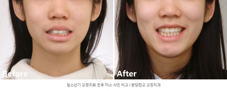 사춘기 치아교정 전후 미소변화 분당교정치과 판교교정치과 서울리인치과